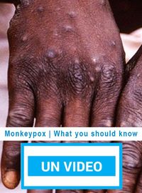 Monkeypox | What you should know